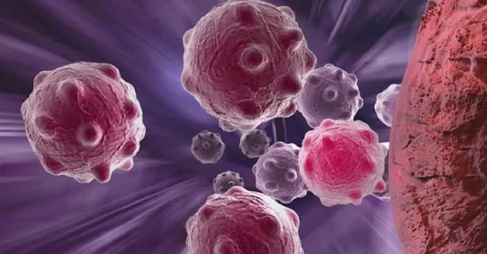 Cancro dell'endometrio avanzato: una nuova terapia aumenta la sopravvivenza