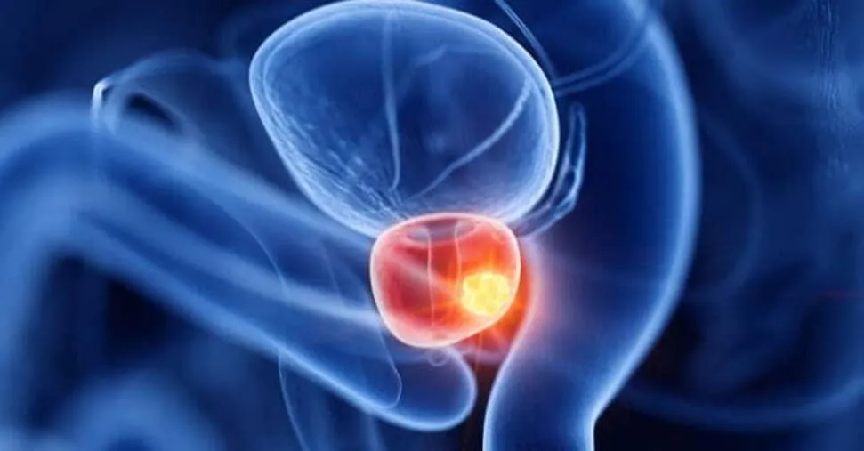 Tumore prostata: bene le nuove strategie, ma senza dimenticare ruolo radioterapia
