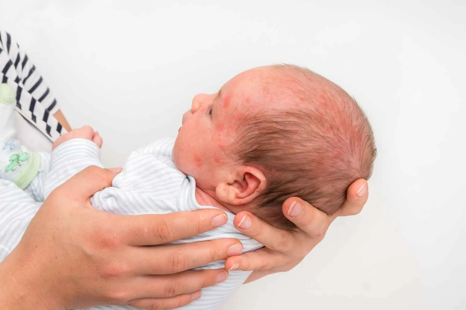 Sfogo cutaneo nei bambini? Il test del bicchiere che ogni genitore dovrebbe conoscere