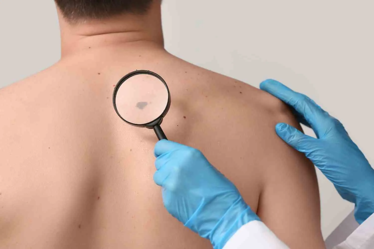 Melanoma, l'errore che fanno tutti sotto il sole (e non è dimenticare la crema)