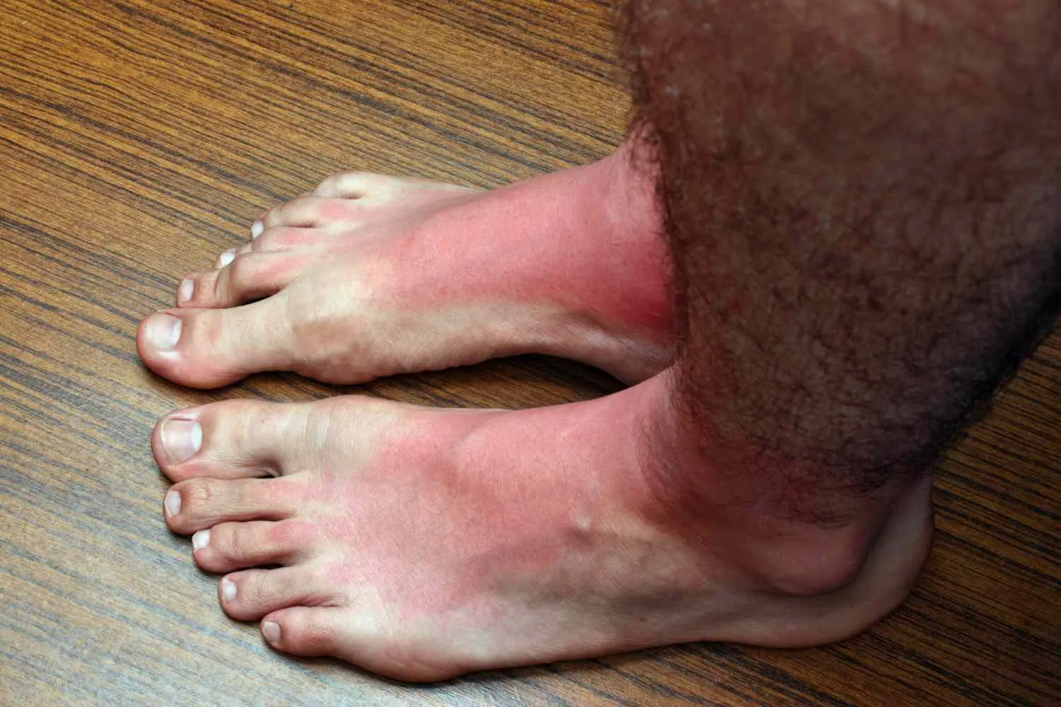 Crema solare: queste sono le zone del corpo che dimentichi sempre di proteggere (e che mettono a rischio la tua pelle)