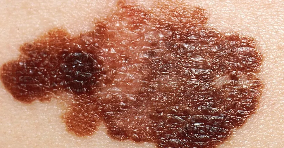 Melanoma avanzato, la nuova pillola  che «spoglia» il tumore e lo rallenta