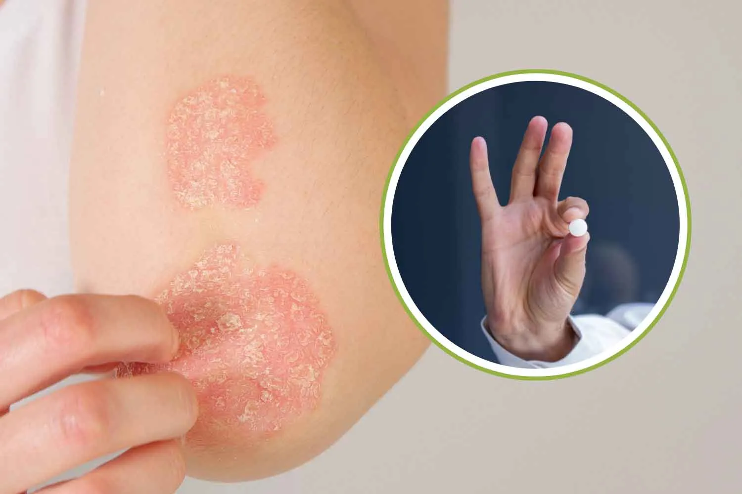 Psoriasi, la nuova pillola mirata supera il primo esame europeo e apre la strada a un trattamento rivoluzionario senza iniezioni
