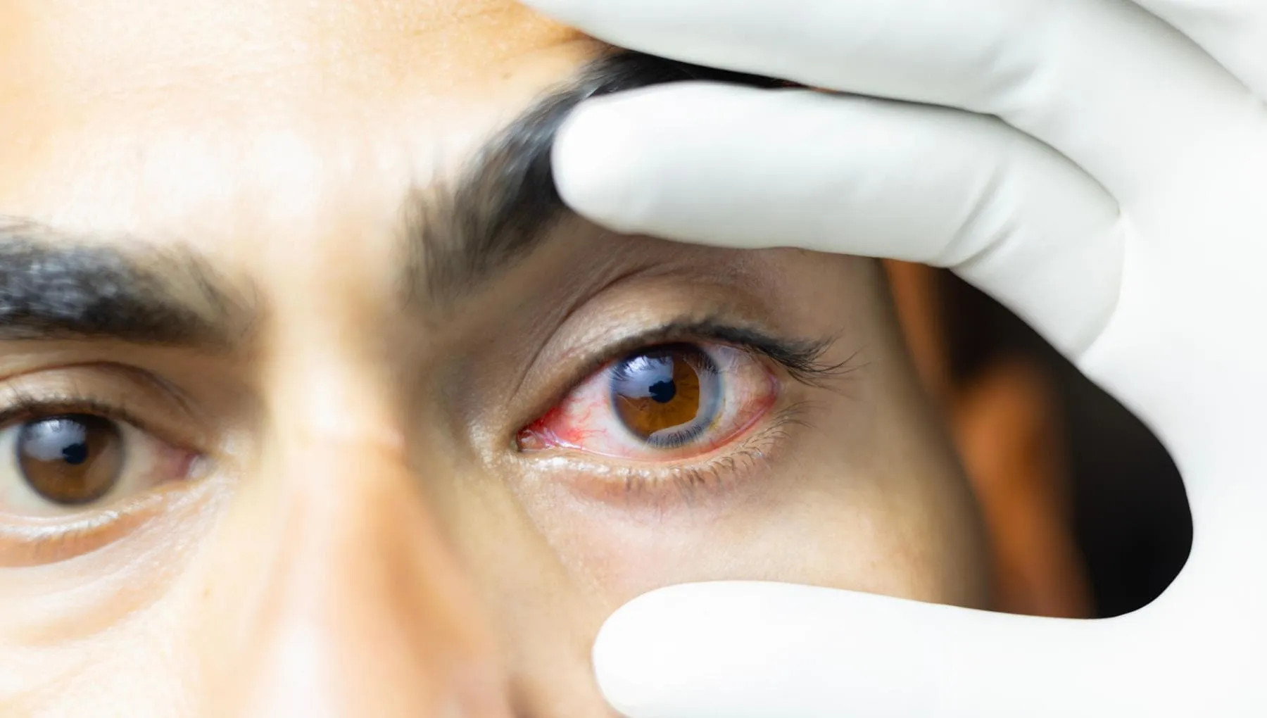 Glaucoma, un paziente su due non sa di averlo