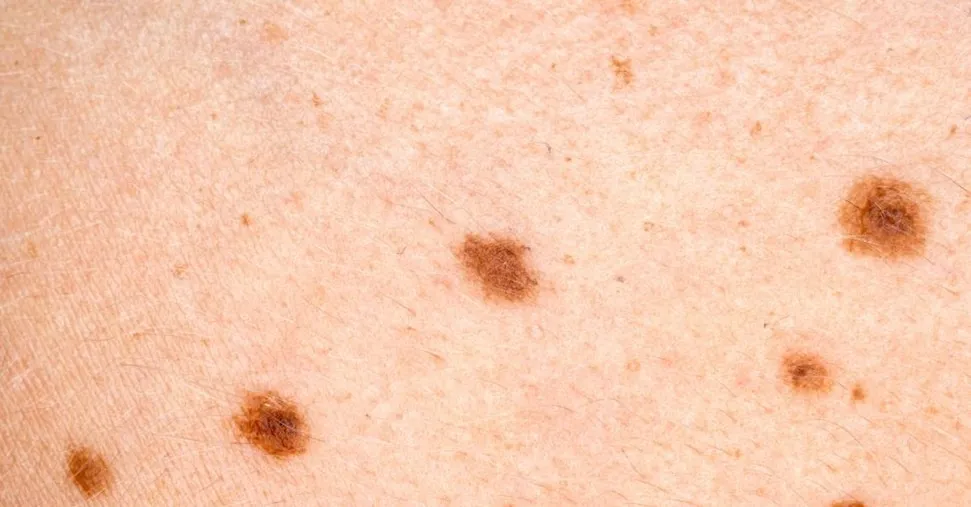Melanoma, il vaccino a mRna taglia  del 49% il rischio di recidiva a 5 anni