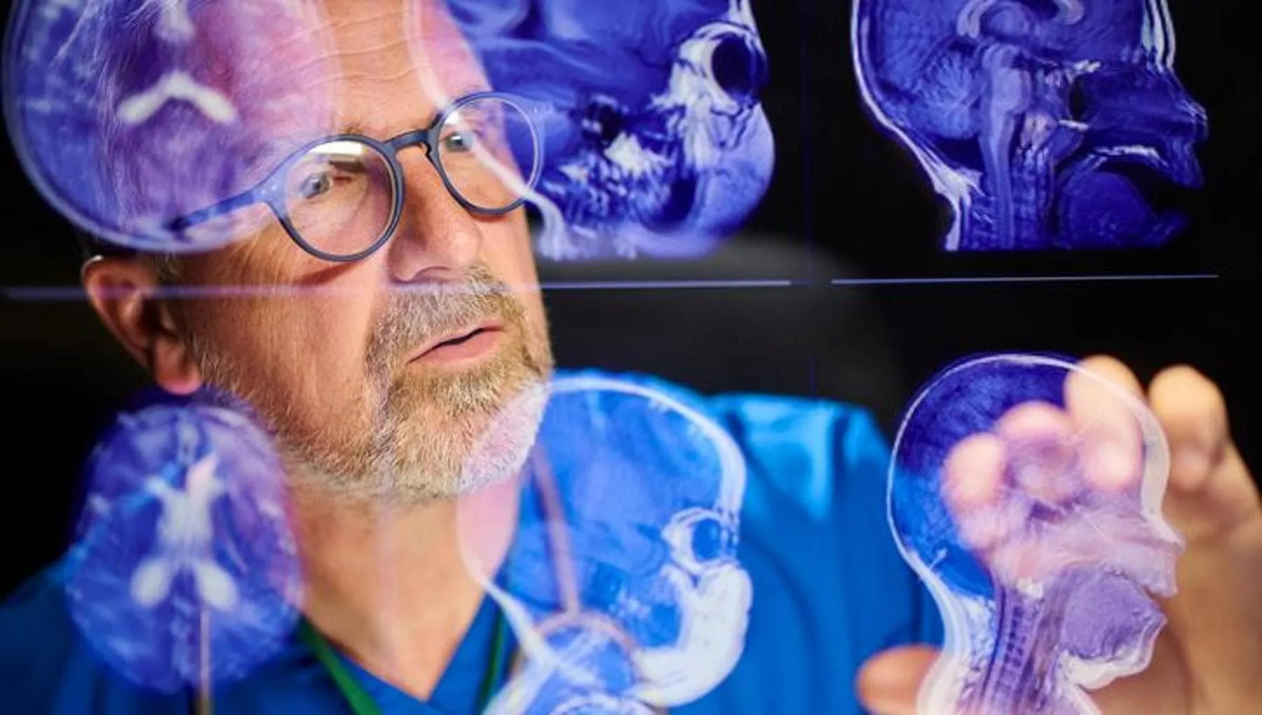 Tumori cerebrali, la nuova frontiera: decifrare la “carta d’identità” del glioma