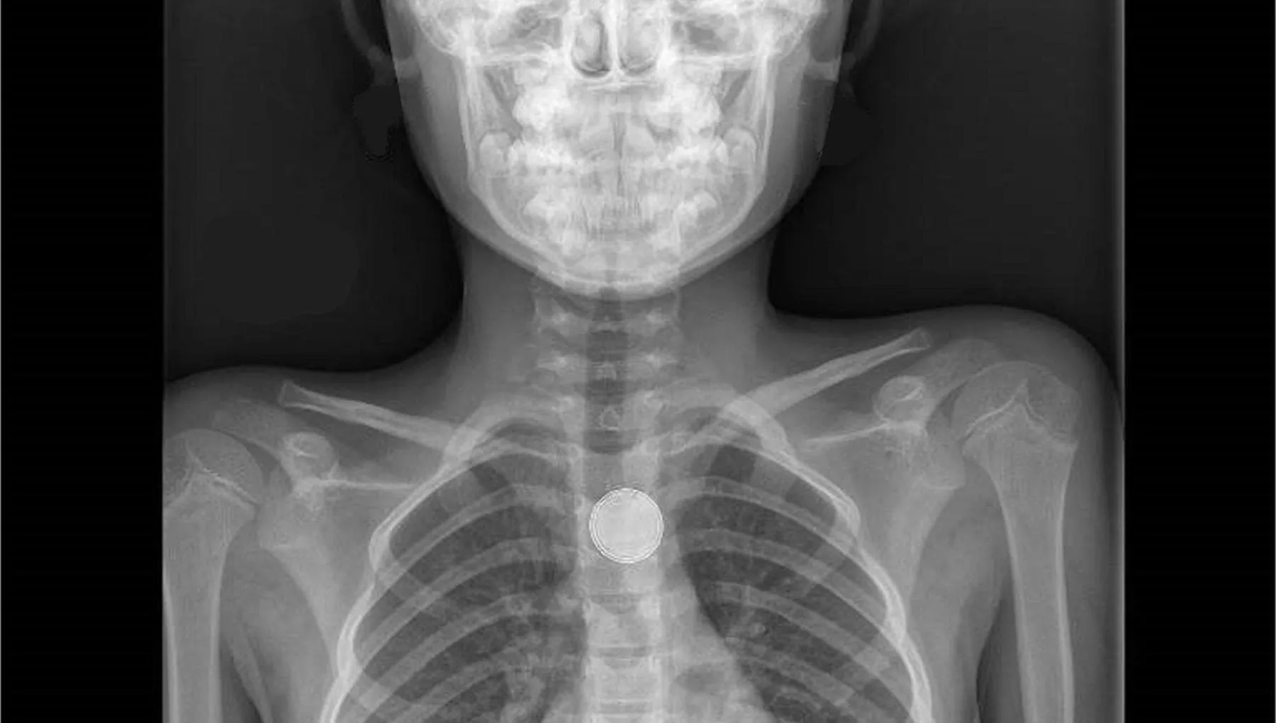 Batterie a bottone, allarme per i bambini: triplicate le lesioni all’esofago
