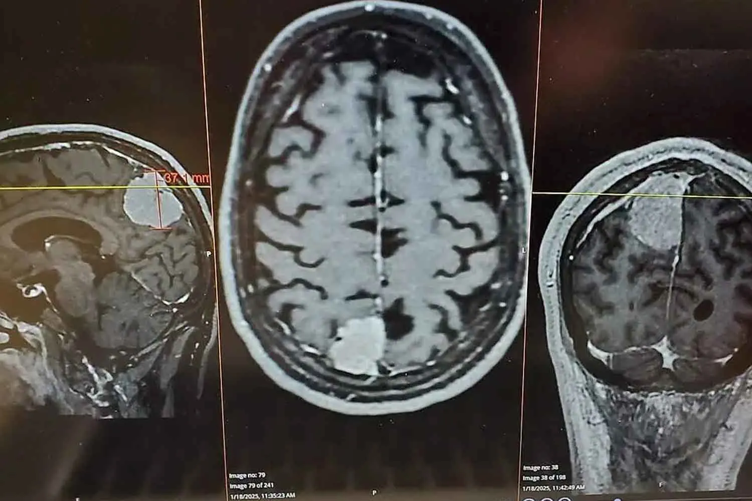 Cancro al cervello: scoperta una nuova strategia per bloccare le cellule tumorali "sul posto"