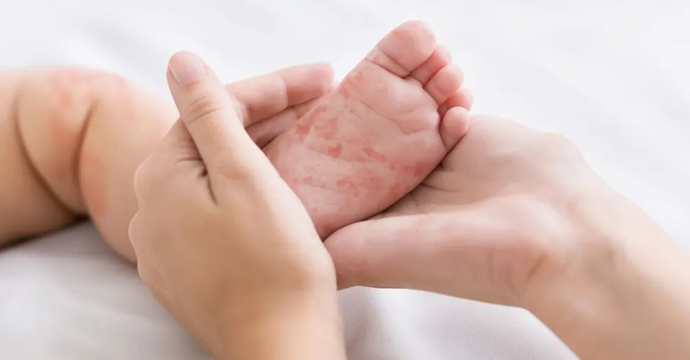 Morbillo, l’allarme dei pediatri:  un malato ne può contagiare 17