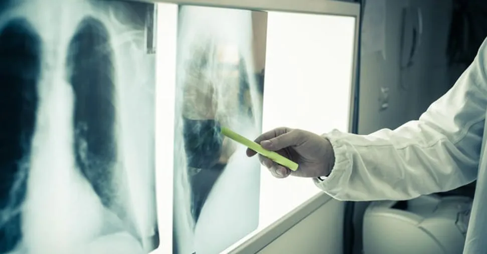 Tumore al polmone: primi risultati con vaccino sperimentale, quasi raddoppiata la sopravvivenza